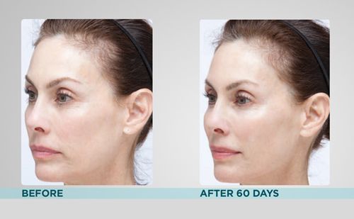 Clarisonic uplift