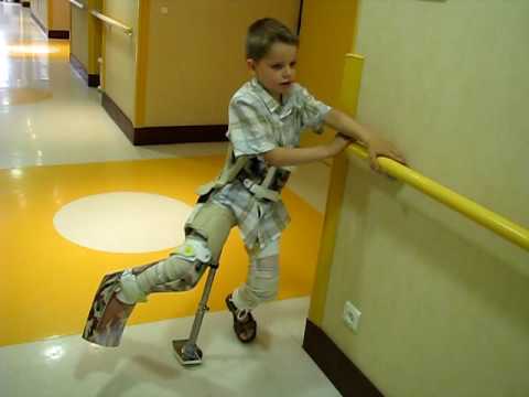 Polio walking calipers