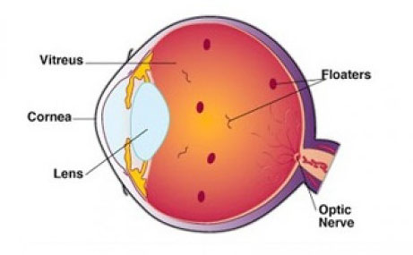 Moorfields eye hospital laser eye surgery