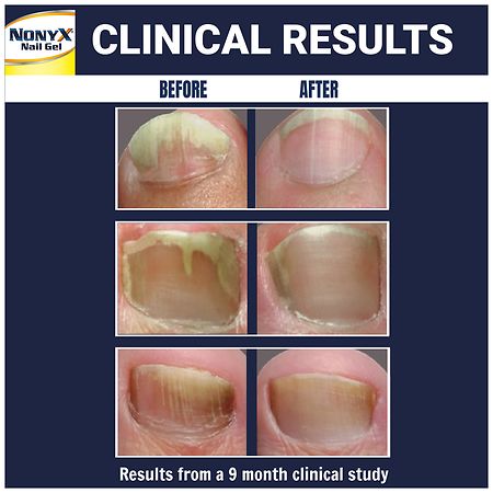 Nonyx nail fungus review